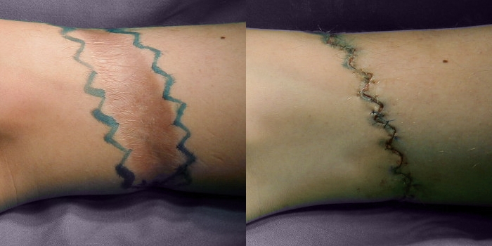 Scar 7 days after W-plastics